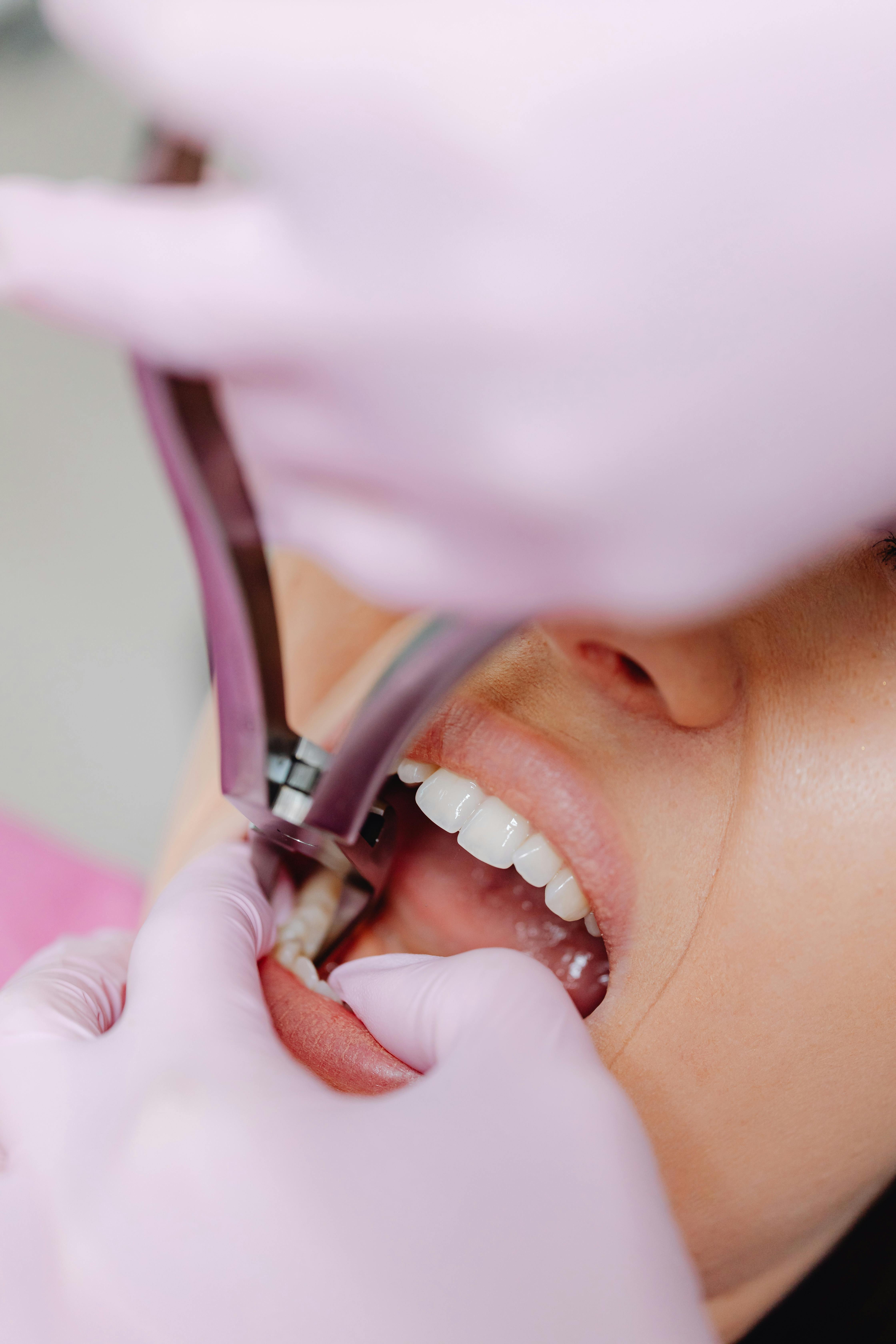 Dental Extractions